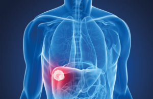 Epatite C a Corato una vera epidemia